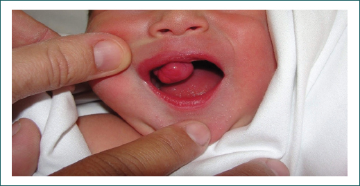 Alteraciones bucales en el bebé recién nacido - Clinica Dental Sciaini